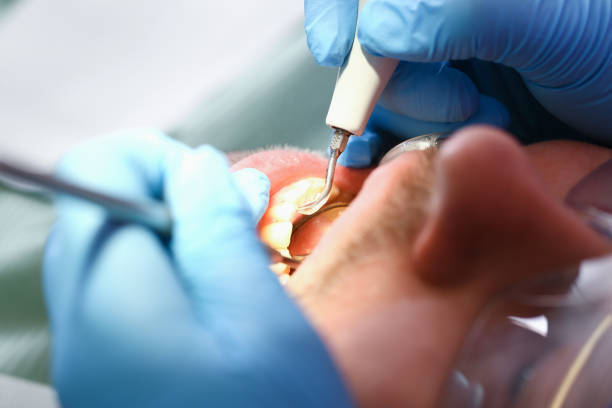 Best Emergency Tooth Extraction in Lewisville, WA